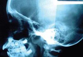 Why Athletes Choose Chiropractic